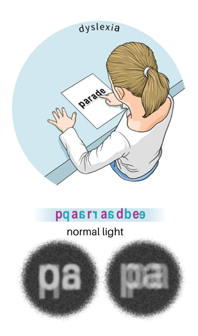 dyslexia